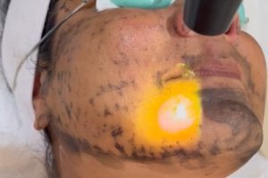 Laser Therapy for Acne
